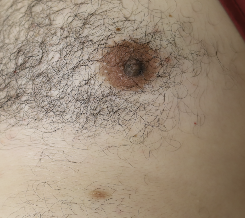 Leiomyoma of areola
